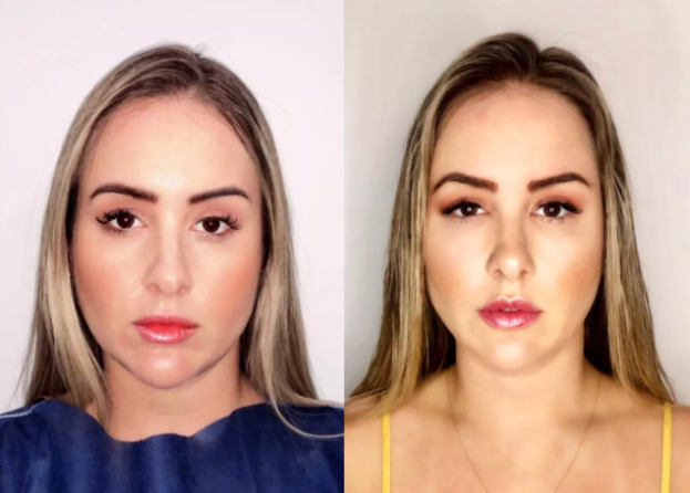 Patrícia Leitte faz harmonização facial e 'antes e depois' impressiona: "Inacreditável"