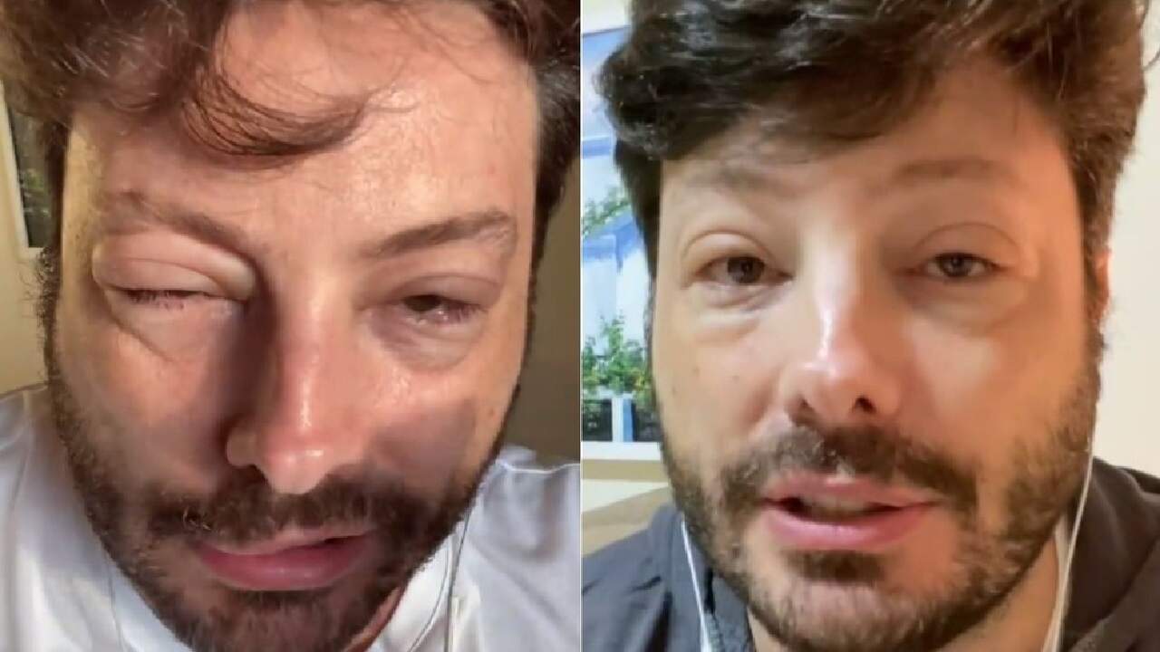 Danilo Gentili surge com rosto deformado após crise alérgica e assusta: “Choque anafilático” - Metropolitana FM
