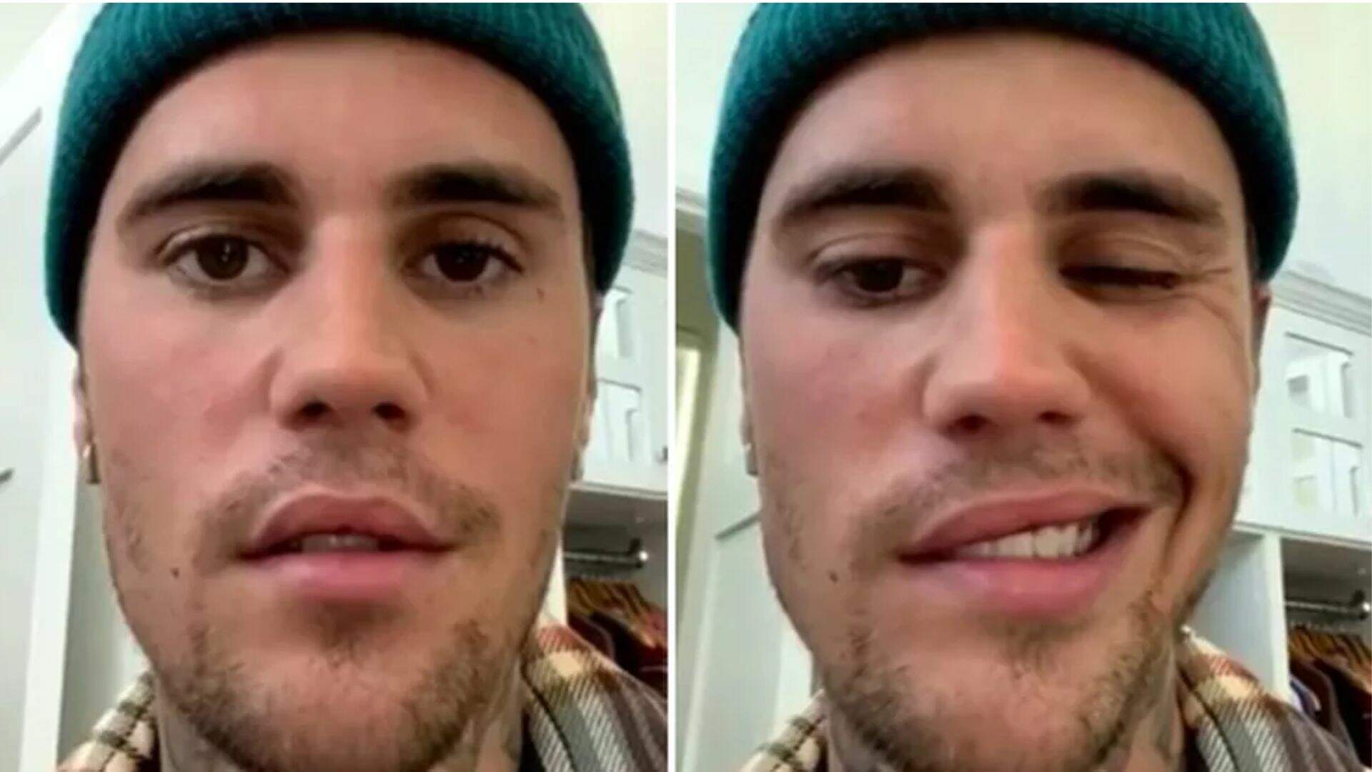 Após surgir com o rosto paralisado, Justin Bieber atualiza fãs sobre estado de saúde
