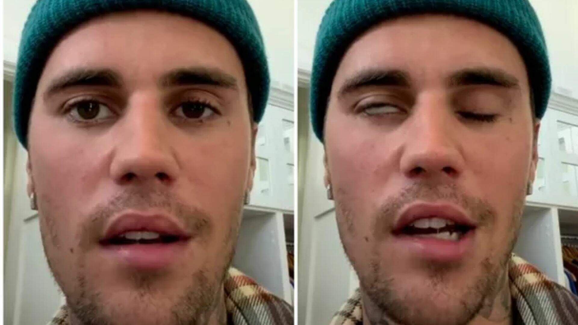 Justin Bieber surge com rosto paralisado, revela diagnóstico preocupante e assusta fãs