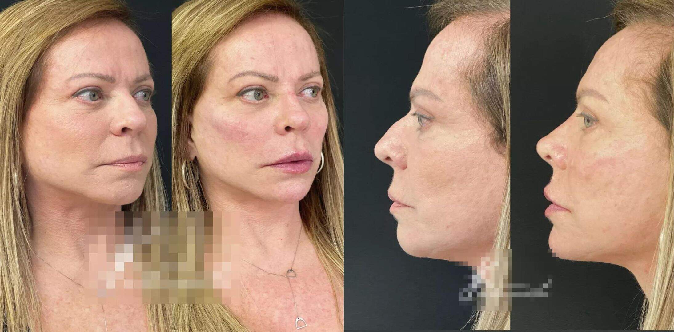 Aos 65 anos, Christina Rocha realizou uma harmonização facial para aparentar mais jovem