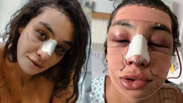 Linn da Quebrada choca com aparência após cirurgia plástica e explica o motivo: “Renascimento”