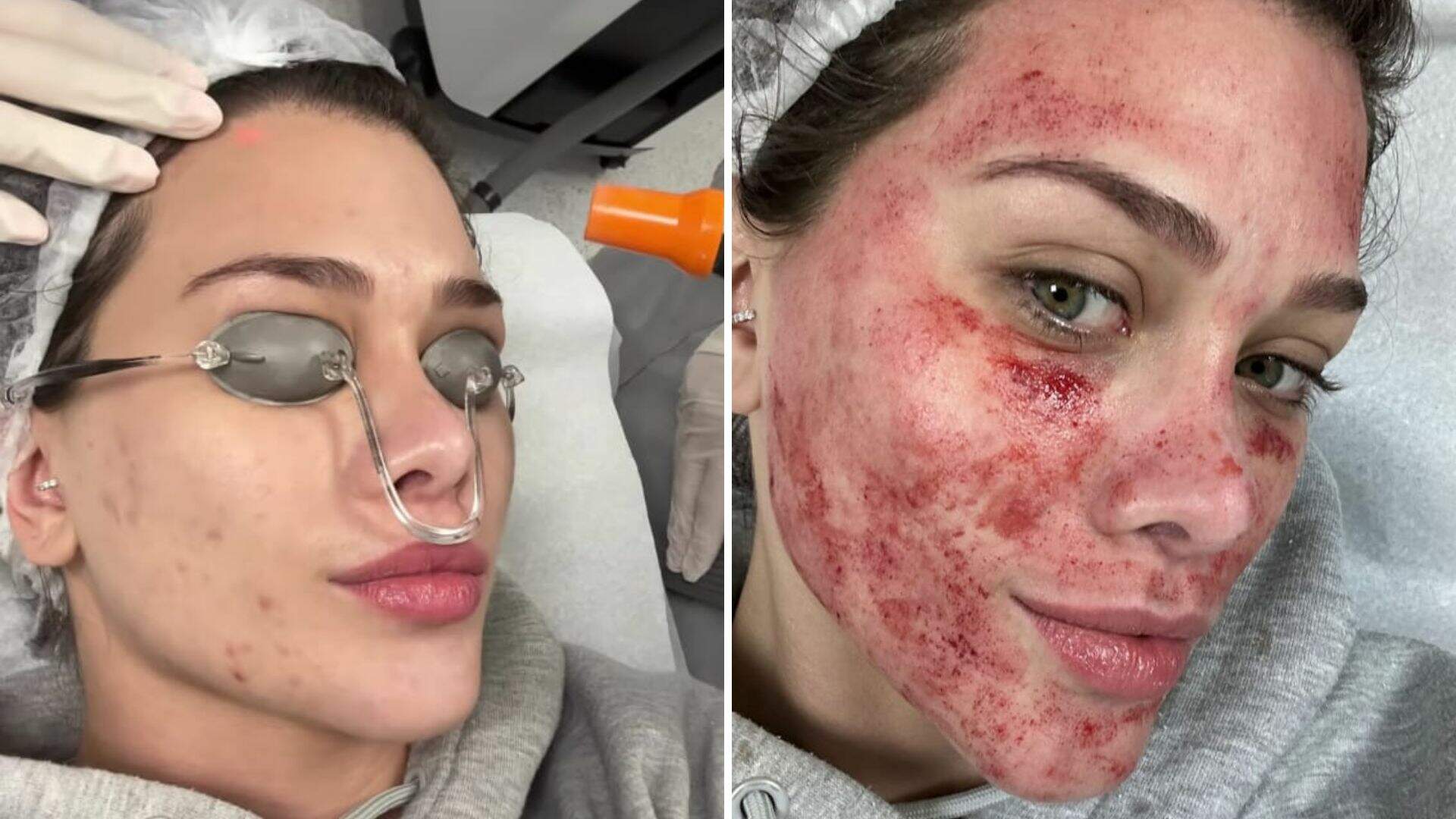 Flavia Pavanelli aparece com rosto sangrando após procedimento e choca internautas - Metropolitana FM
