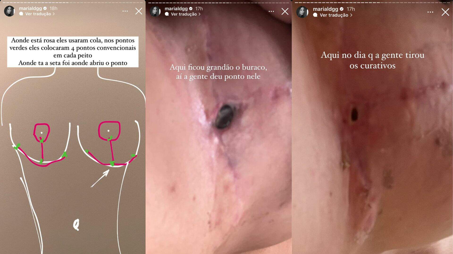 Maria Lina Deggan mostra os pontos de sua cirurgia nos seios