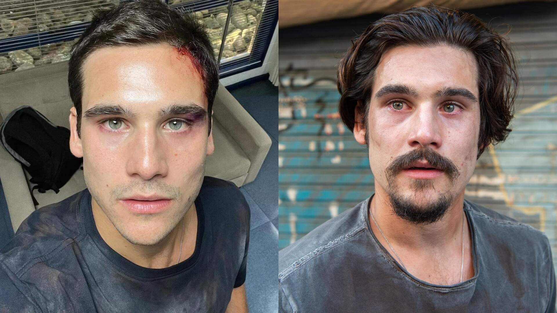 Todas as Flores: Nicolas Prattes exibe ferimentos graves e fãs se preocupam: “O que aconteceu?” - Metropolitana FM