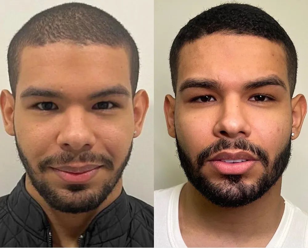 Antes e depois da harmonização facial de Vyni