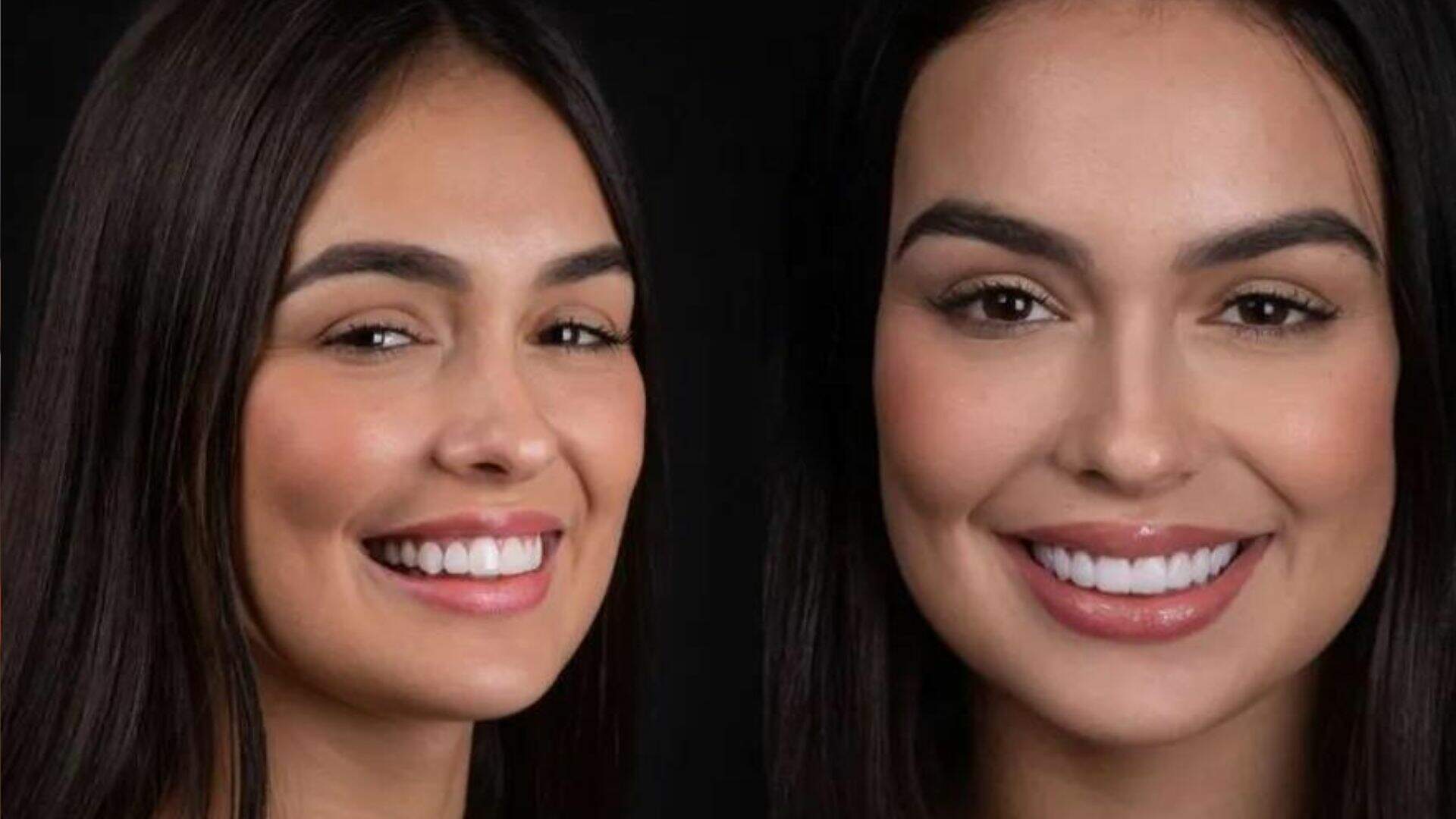 Após BBB 23, Larissa Santos troca lentes de contato dos dentes e resultado surpreende: “Meu sorriso me incomodava” - Metropolitana FM