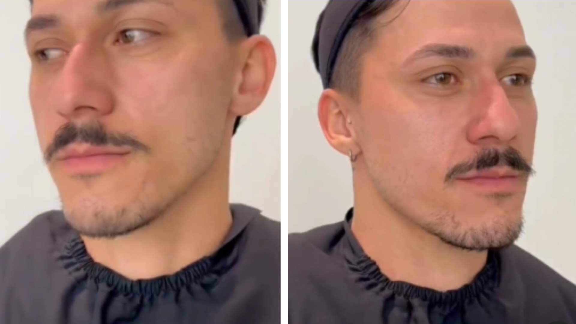 Homem mostra resultado chocante do seu transplante de barba e deixa internautas boquiabertos