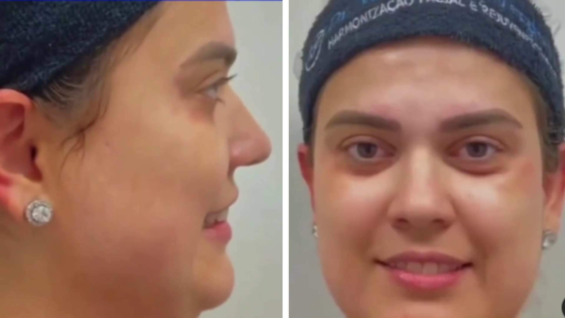 Médico divulga antes e depois de procedimento no rosto de paciente e resultado toma proporções extraordinárias - Metropolitana FM