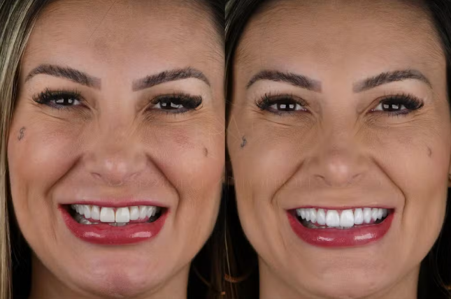 Sorriso de Andressa Urach: antes e depois 