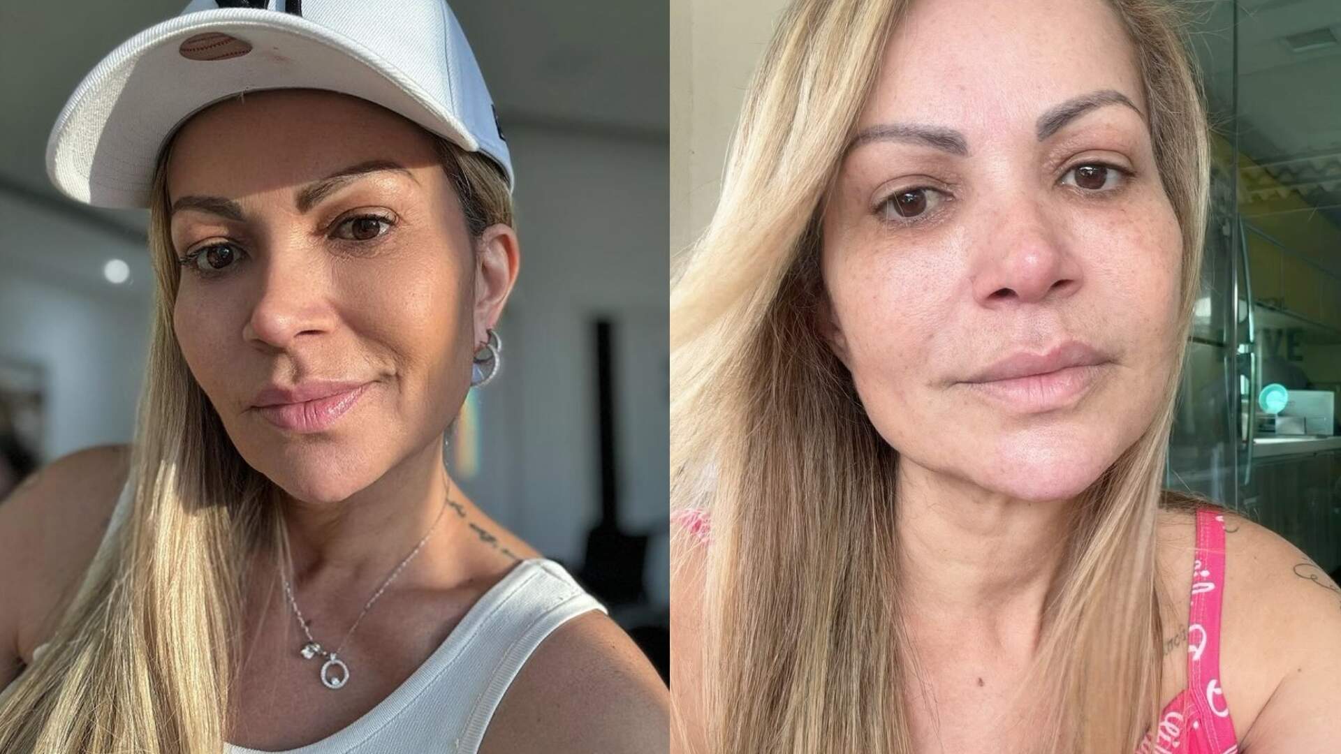 De cara limpa, Solange Almeida aparece nas redes sociais após passar por cirurgia de emergência