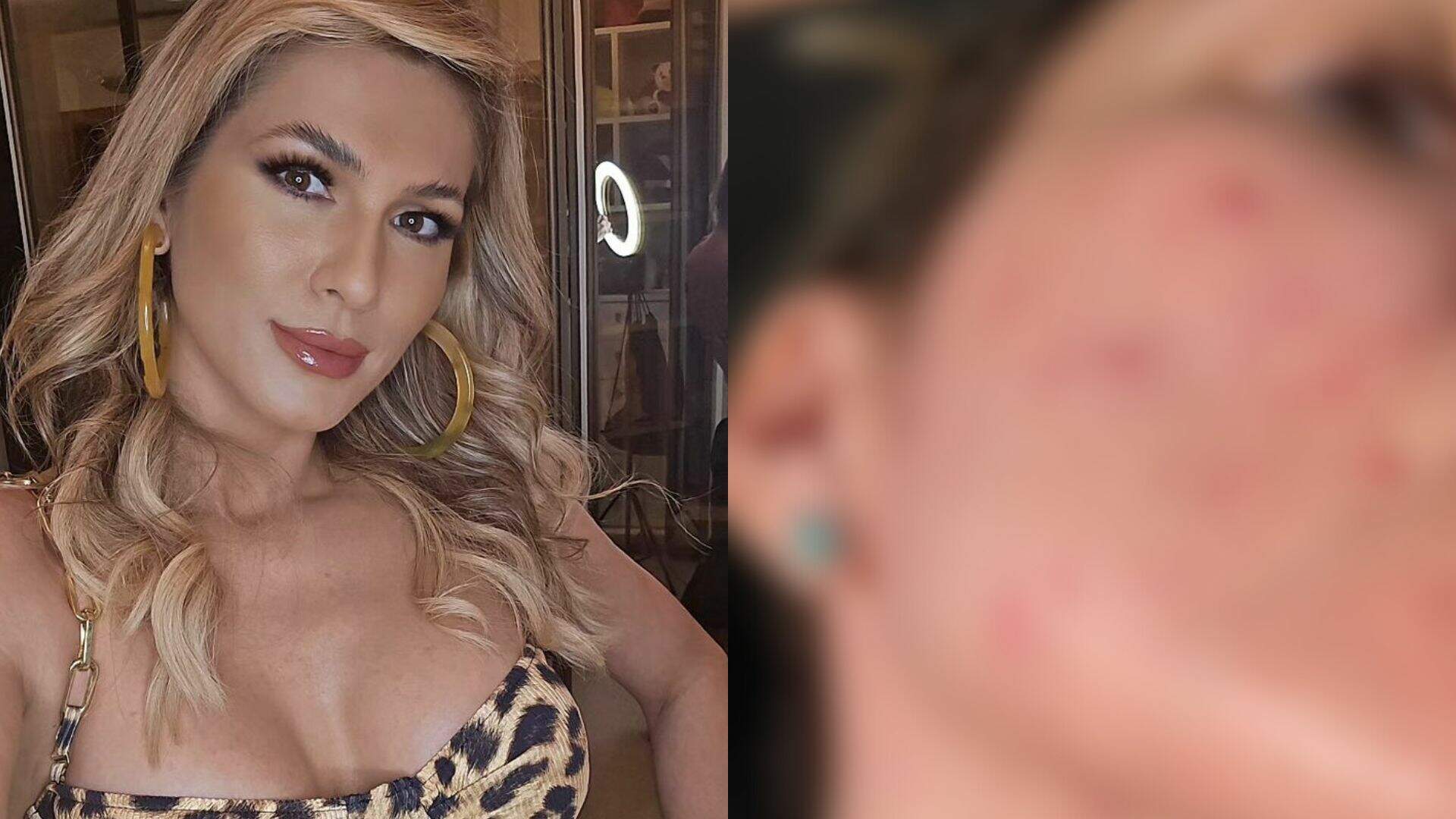 Vida real! Lívia Andrade mostra crise de rosácea na pele durante as gravações - Metropolitana FM