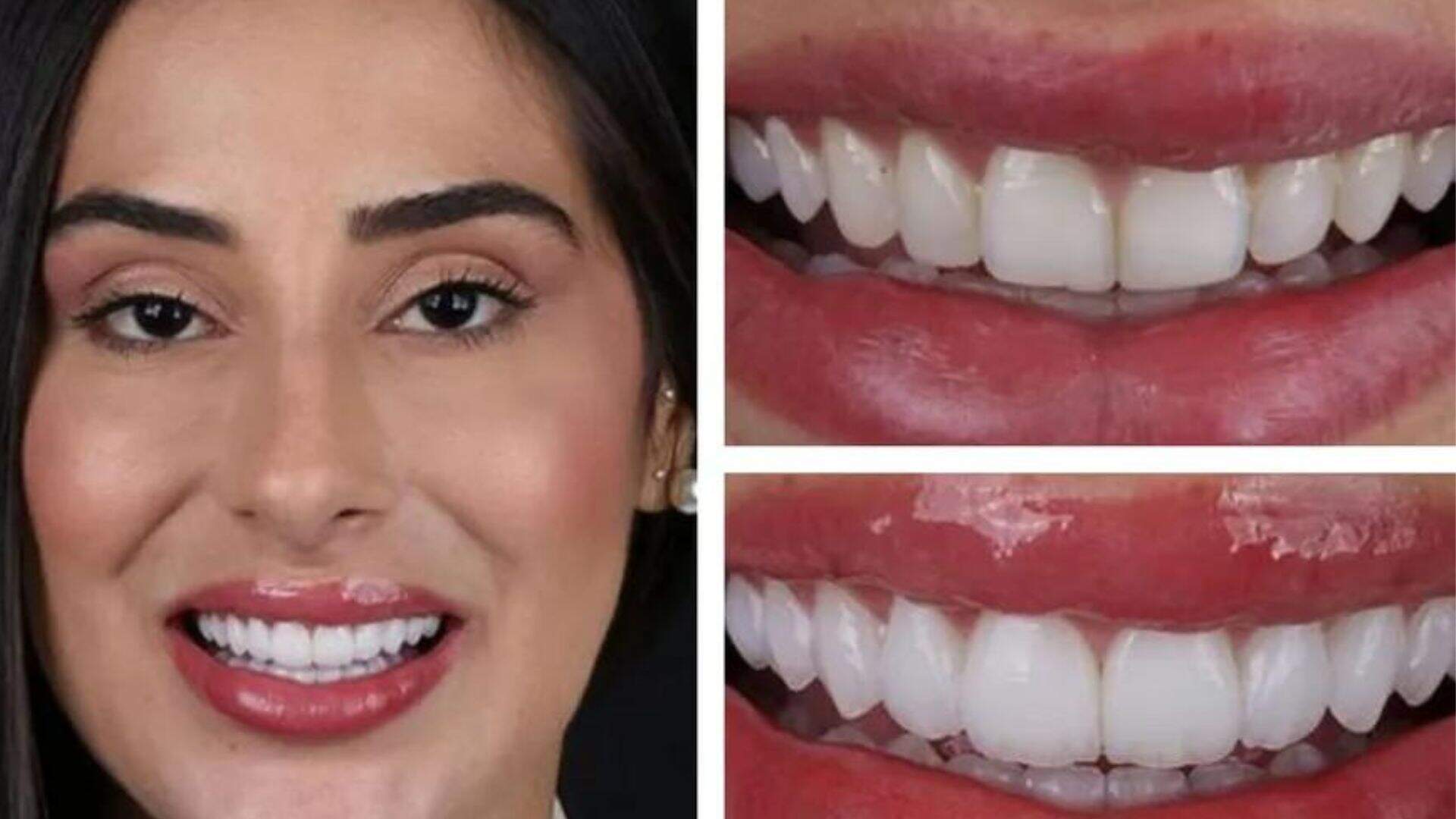 Ex-BBB Deniziane coloca lentes de porcelana nos dentes; confira o resultado