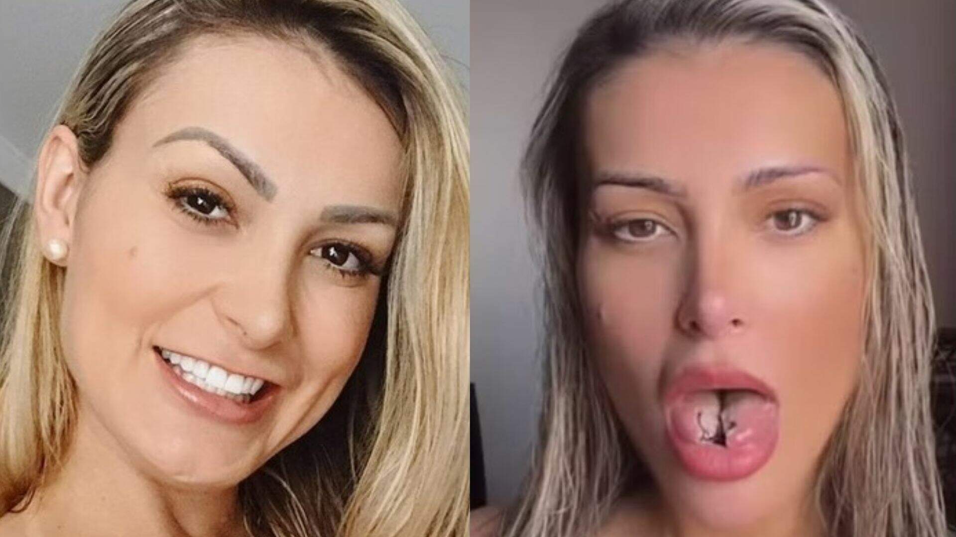 Andressa Urach faz cirurgia de 'bifurcação da língua'