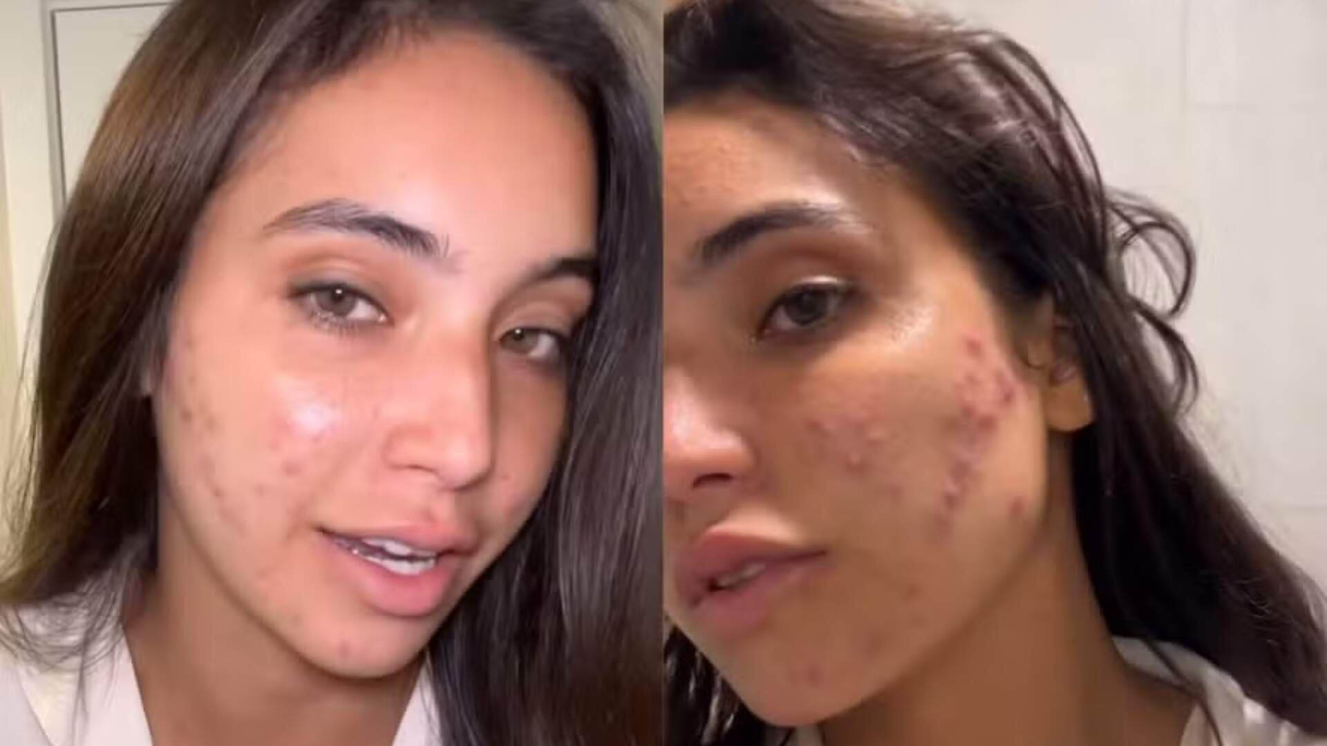 Vanessa Lopes relembra traumas do ‘BBB 24’ e expõe problemas com a pele: “É uma reação”